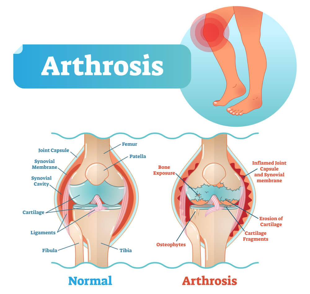 آرتروز چیست